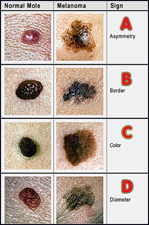 ตารางเปรียบเทียบไฝปกติ (Normal Mole) กับ ไฝที่อาจก่อให้เกิดมะเร็งผิวหนัง (Melanoma)