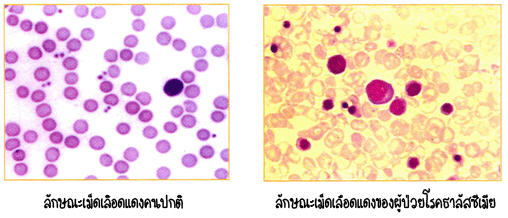 เปรียบเทียบลักษณะเม็ดเลือดคนปกติ กับเม็ดเลือดแดงของผู้ป่วยโรคธาลัสซีเมีย