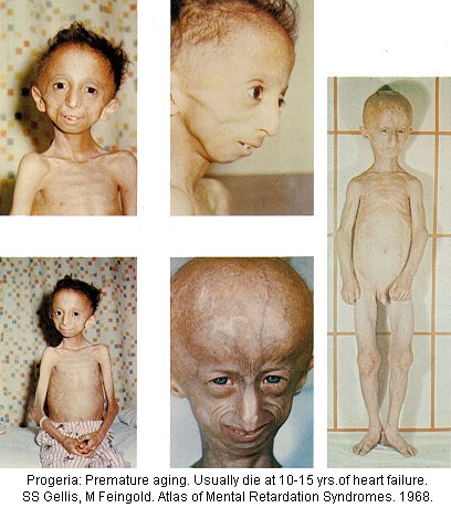 progeria1-may53