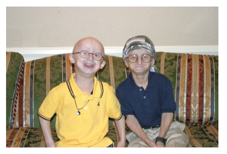 progeria2-may53