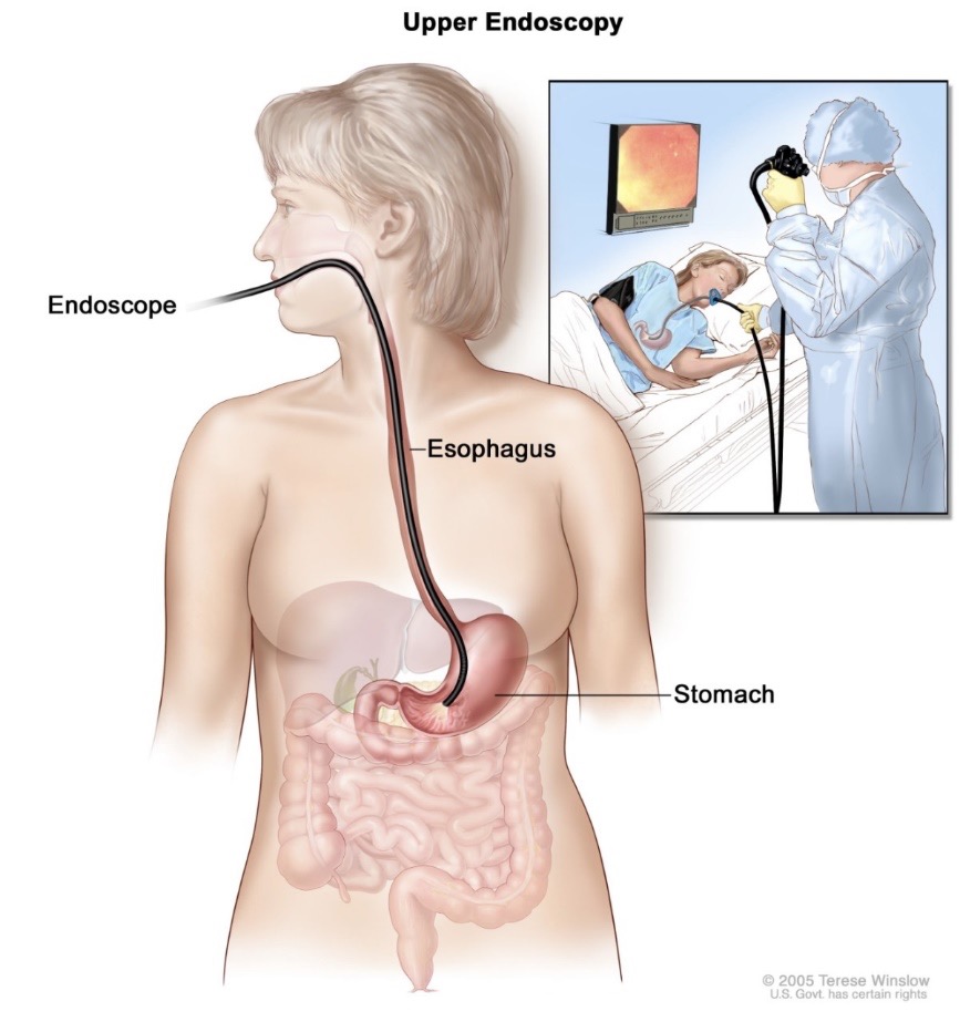 การใช้เอนโดสโคปสอดผ่านหลอดอาหารเพื่อตรวจกระเพาะ